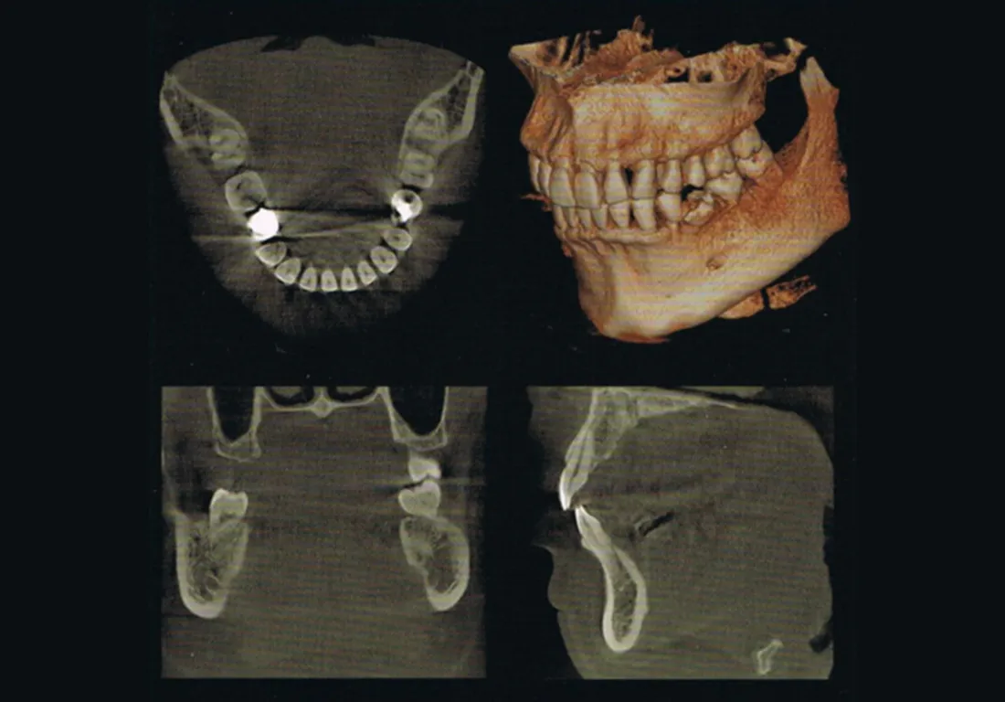 Dental-Arch FOV(歯列弓型撮影領域)を新搭載/高解像度ボクセルサイズ/Dose Reduction機能