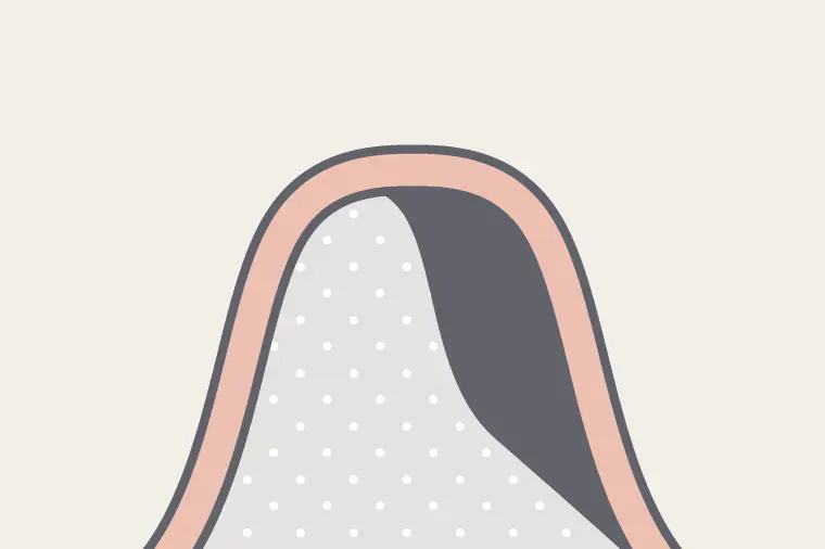 インプラントの埋入