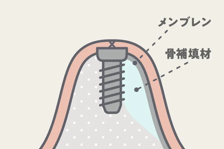 骨補填材の充填と保護