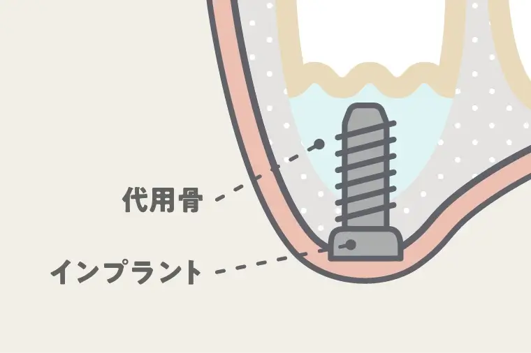 骨補填材(人工骨)を充填する