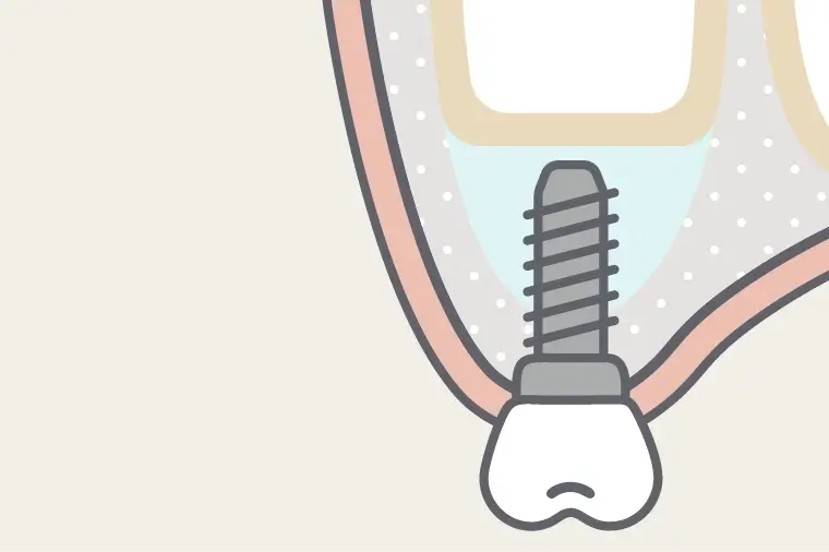 人工骨が骨化してからインプラント埋入