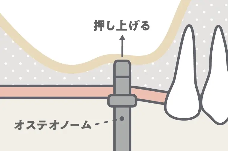 上顎骨に穴を開ける