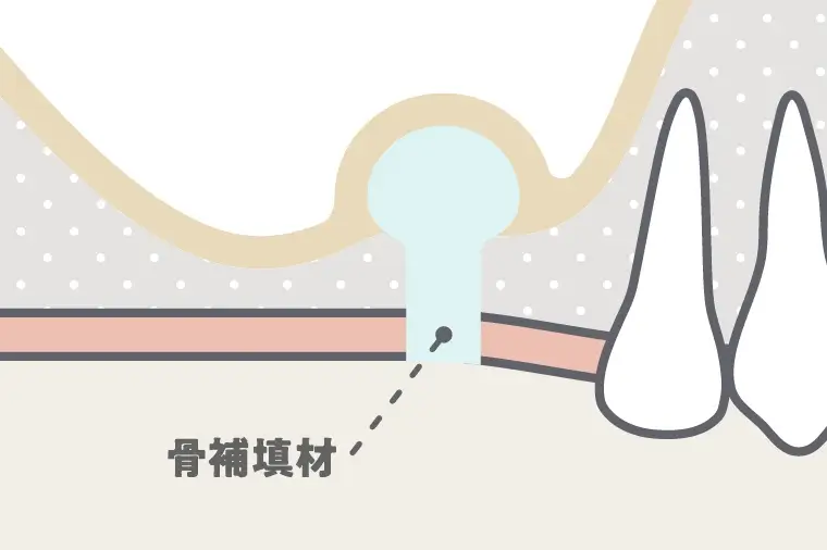 骨補填材(人工骨)を充填する