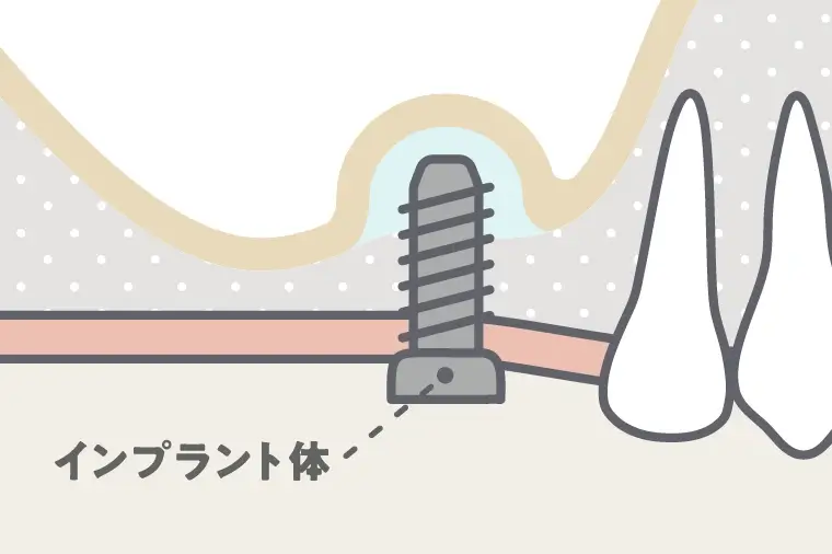 インプラントの埋入