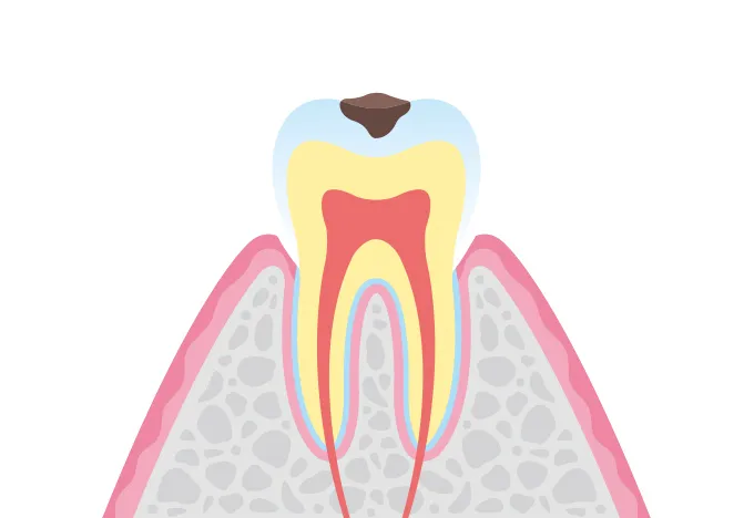 C1 エナメル質の虫歯