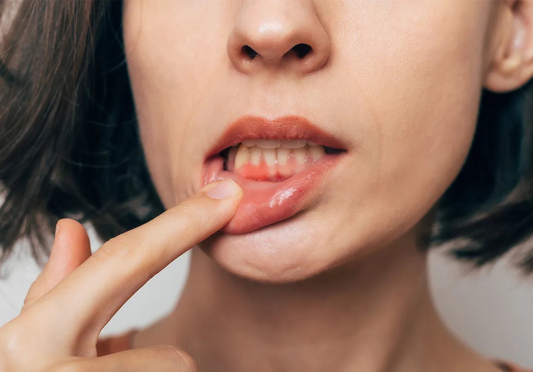 歯周病になるとどうなるの?