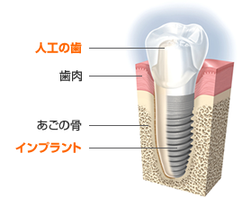 インプラント治療ってなに？和歌山にある辻岡歯科医院の院長がお答えします。