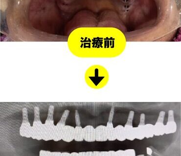 50代男性のインプラント事例