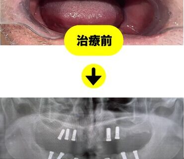 60代男性のインプラント事例