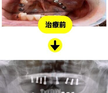 80代男性のインプラント事例