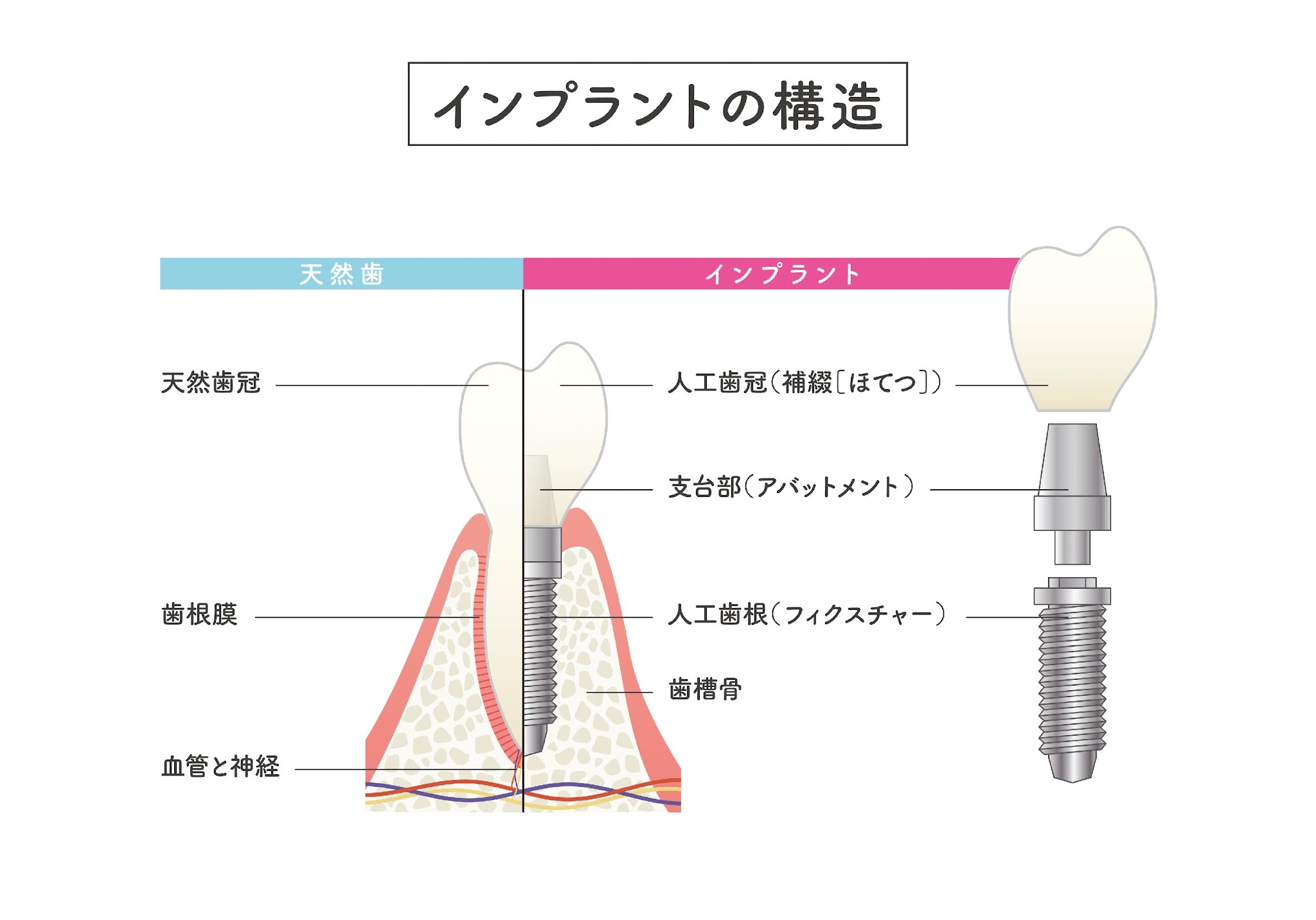 インプラントの違和感はなぜ起きるのか