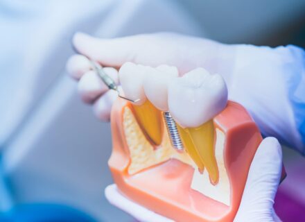 インプラントに生命保険は使える?給付の条件と費用を抑える方法