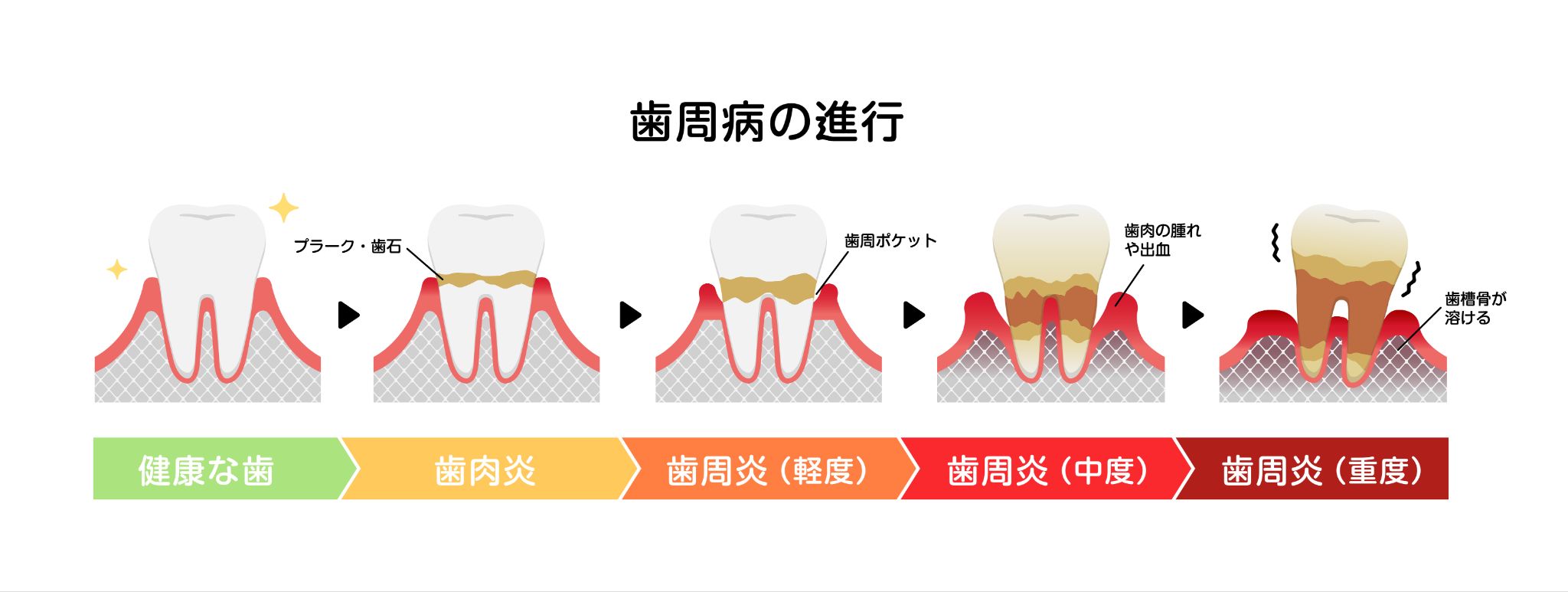歯周病の進行度と残せる歯の境目