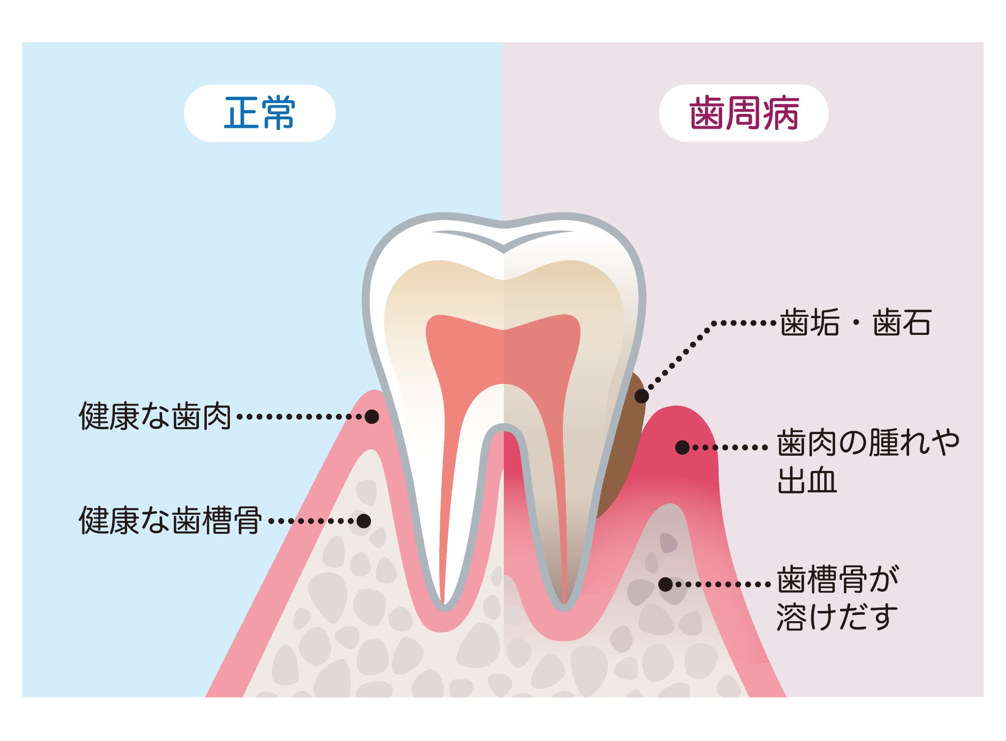 歯周病でズキズキ痛むのはどんな状態か